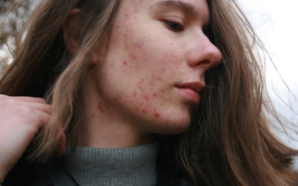 Guide to Hormonal Acne Treatment: How to Manage, Prevent, and Treat Hormonal Breakouts