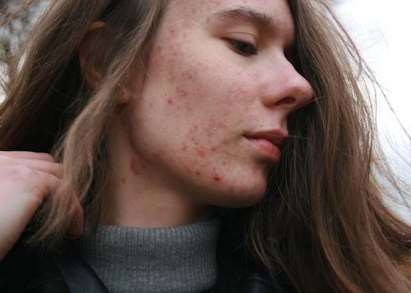 Guide to Hormonal Acne Treatment: How to Manage, Prevent, and Treat Hormonal Breakouts